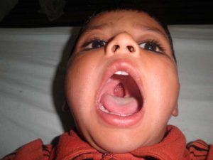 Pictures of a child with palate cut before surgery